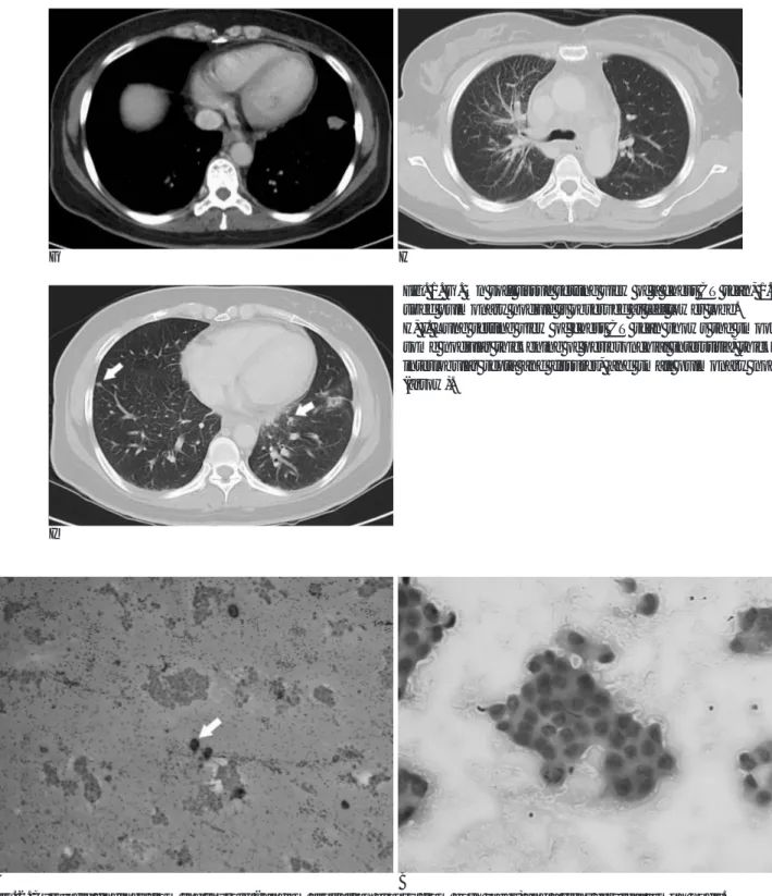 Fig. 1. G. On soft tissue setting view of a chest CT scan, 1.5 cm sized pulmonary nodule is observed at left lower lobe.