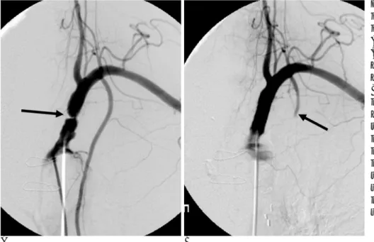 Fig. 3. 55-year-old man who had a pri- pri-or left internal mammary-cpri-oronary  by-pass graft.
