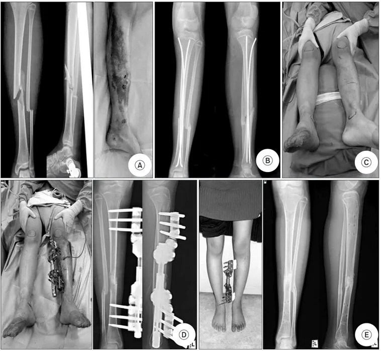 Figure 1. (A) A 15-year-old female sustained open fracture of the tibia and fibula in Gustilo-Anderson type IIIA combined with brain injury