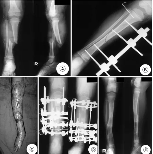 Figure 2. (A) A 5-year-old male sustained  open fracture of the tibia in  Gustilo-An-derson type IIIC caused by traffic accident