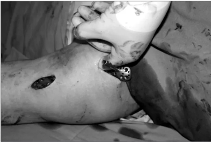 Figure 2. A K-wire is inserted to the proxi- proxi-mal humerus through the plate and  reduc-tion is achieved by purchasing the cortical  screw to the humeral shaft.