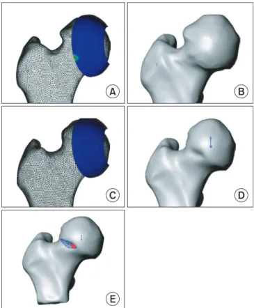 Figure 4. (A, B) Preoperative finite element model of a patient in group  A. A small portion of femoral head neck junction had an increased  contact pressure which indicates a clinical “bump”