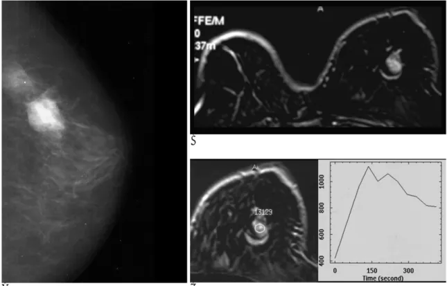 Fig. 1. DCIS with microinvasion with enhancing Mass at 63-year-old woman 