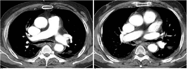 Fig. 4. The CT scans of the chest show the complete resolution of thrombus in the pulmonary artery.