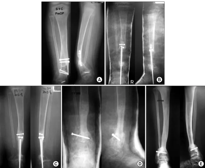 Fig.  1.  Case 4.  (A)  Bony union  was failed  after  bone  graft at  other  hospital