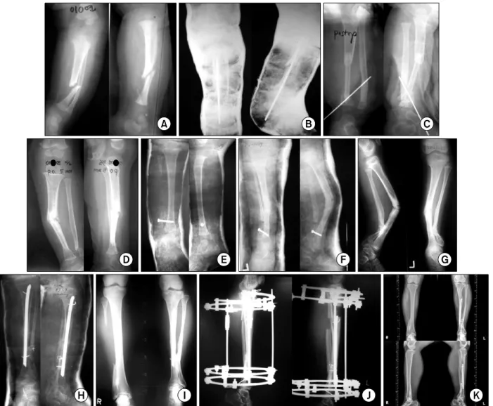 Fig.  3.  Case  3.  (A)  Initial  radiograph.  (B)  At  other  hospital,  bone  graft  was  performed  and  bony  union  was  failed