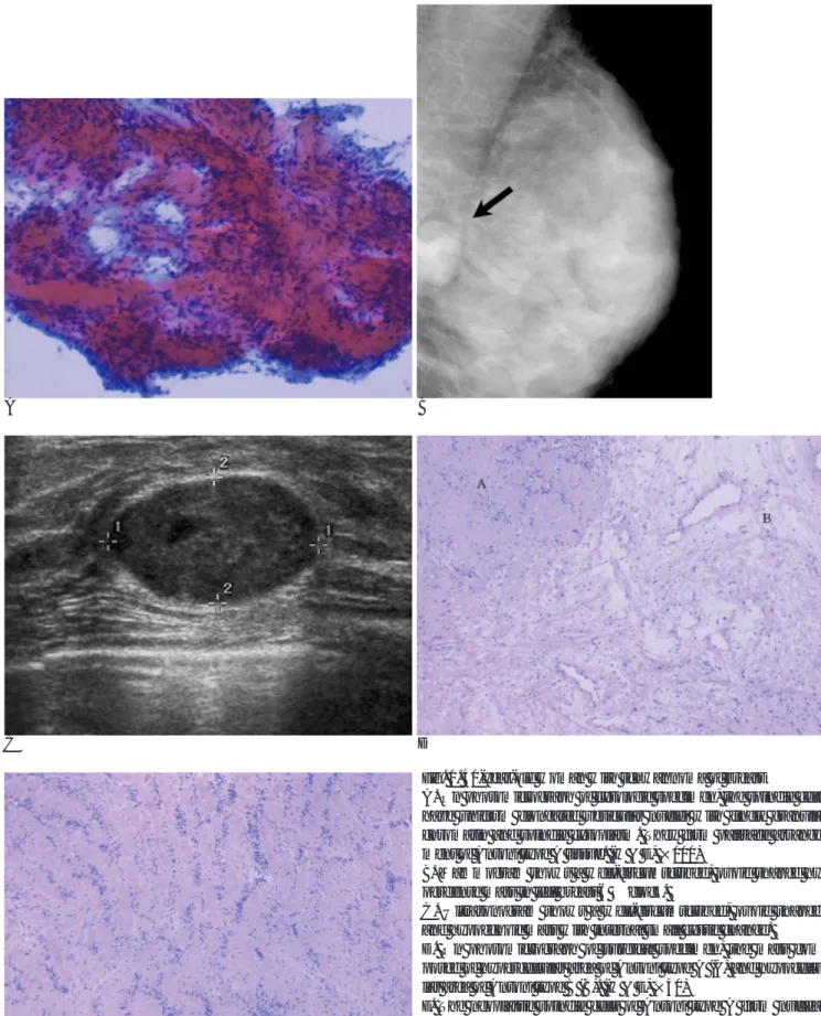 Fig. 1. 41-year-old woman with schwannoma of breast