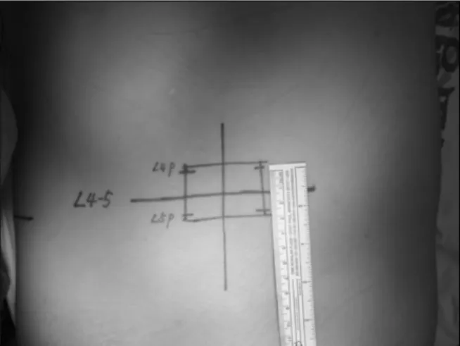 Fig.  2.  Tilting  patient  against  the  operator  makes  it  easy  to  approach  during  operation