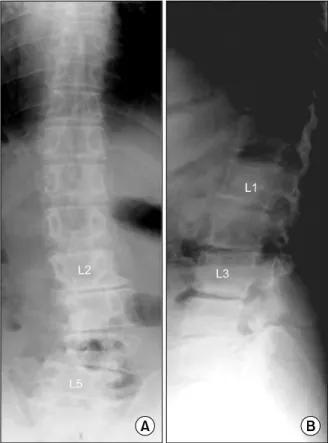 Table  2.  Incidence  of  Proximal  ASD  according  to  the  Level  of  Upper  Instrumented  Vertebra