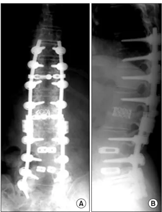 Fig.  5.  (A,  B) We  performed  revision surgery extending fusion  to T10.  의 발생률과 위험인자에 대한 분석이 필요하다