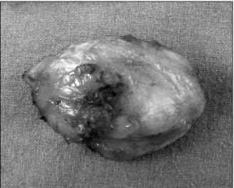 Fig.  3.  The  excised  speciment  is  cutted.  A  retained  sponge  material  was  found  within  the  paraspinal  mass.