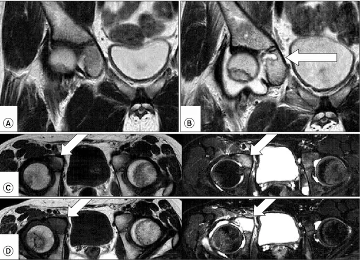 Fig.  1.  (A)  T2  weighted  magnetic  resonance  imaging  of  a  13-year-old  boy (case 1)  with pain  in the right hip was normal