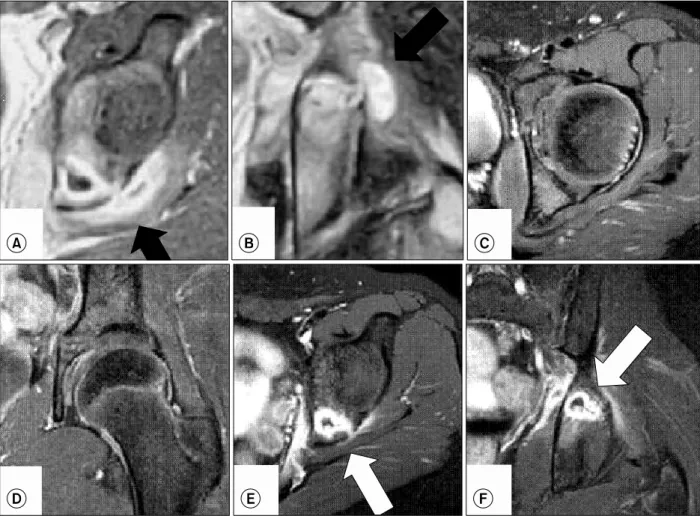 Fig.  2.  A  boy  (case  2)  age  11-year-old  presented  with  a  left  hip  joint  pain  and  a  recent  minor  trauma  history
