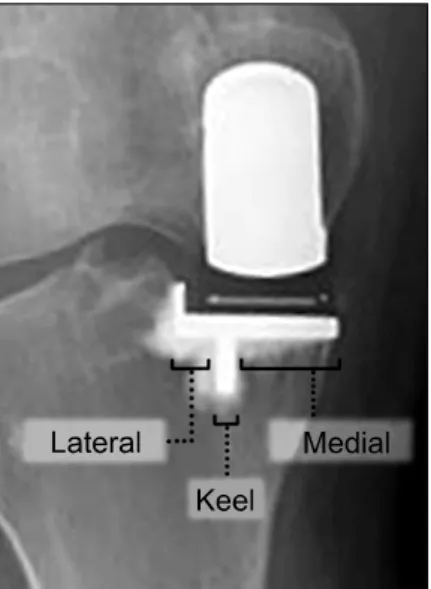Fig.  2.  The  three  areas  of  the  tibial  component  evaluated  to  determine  the  extent  of  radiolucency.