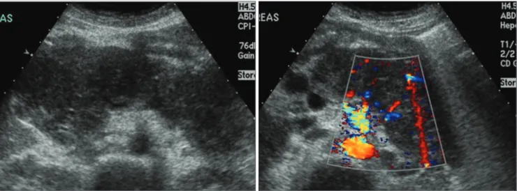 Fig. 1. A. Ultrasonogram shows diffuse enlargement of pancreas with markedly heterogeneous internal echo and contour bulging of the head and tail of pancreas.