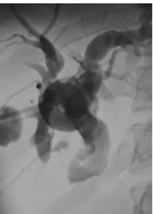 Fig. 6. Percutaneous transhepatic cholagiogram shows dilated intrahepatic duct and complete obstruction of common bile duct