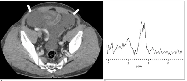 Fig. 5. Serosanguinous fluid with debris and benign fluid in a 63-year-old man who underwent an operation for cholecystitis