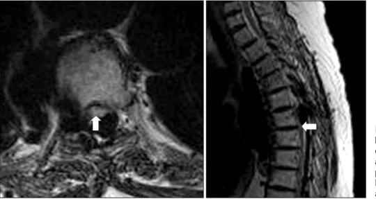 Fig.  2.  T-spine  MRI  shows  huge dilated azygous and  epi-dural  veins  causing  osteolysis  at the vertebral body and  com-pressing  spinal  cord  (Arrow)