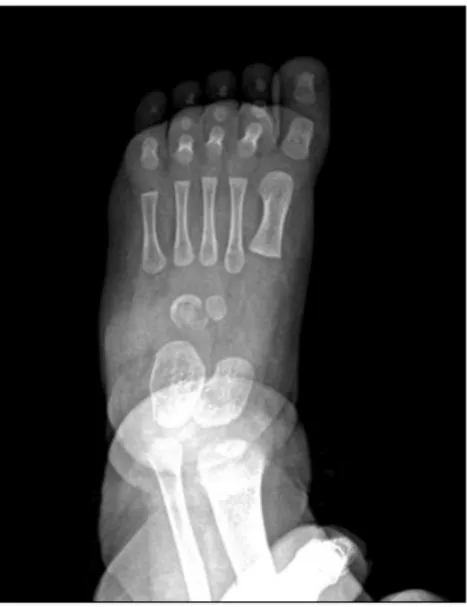 Fig.  1.  AP  radiograph  of  the  foot  shows  diffuse  osteolytic  lesion and  erosions  at  the  peripheral  margins  of  the  cuboid.