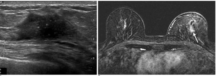 Fig. 1. 49-year-old woman with invasive ductal carcinoma in left breast.