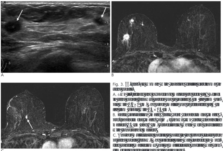 Fig. 3. 66-year-old woman with invasive ductal carcinoma in right breast.