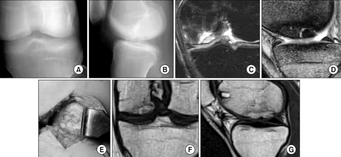 Fig.  2.  These  photos  are  preoperative  radiographs  (A,  B)  and  MR  images  (C,  D)  of  22  years  old  patient  with  a  post  traumatic  osteochondral  defect  of  the  medial  condyle  and  intraoperative  finding  (E)  during  operation