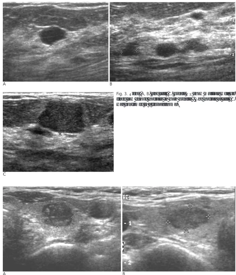 Fig. 3. Right (A, B) and left (C) breast US show multiple well de- de-fined low echoic nodules in both breasts 