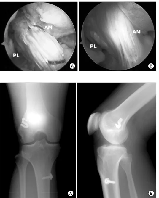 Fig.  5.  Arthroscopic  findings  show double bundle ACL  recon-struction  immediately   postope-ratively (A) and well  synovial  co-veraged  and  vascularized  grafts  without  laceration  or  elongation  at  postoperative  8  months  (B).