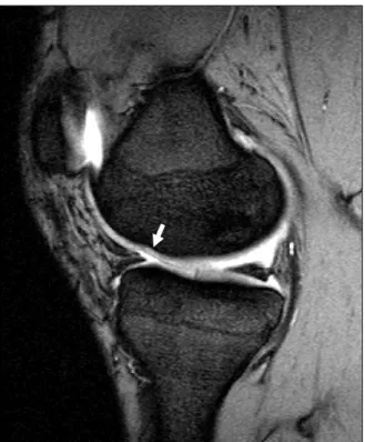 Fig.  7.  MRI  at  38  months  after  microfracture  showed  poorly  covered  cartilage