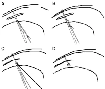 Fig.  1.  The  RapidLoc  device  is  composed  of  3  elements:  the 