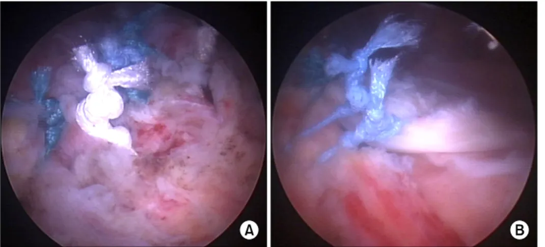 Fig.  1.  Post-operative  findings  after  arthroscopic  massive   ro-tator  cuff  repair