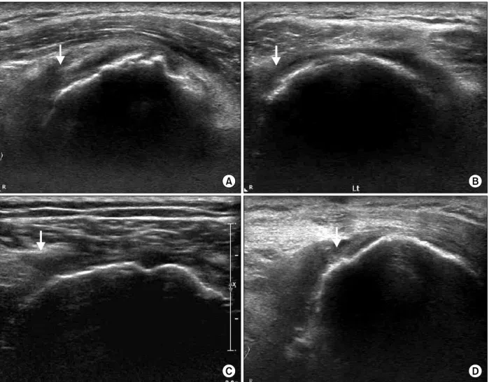 Fig.  2.  Supraspinatus  long  axis  view  in  ultrasonographic  evaluation  for  massive  tear