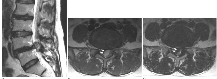 Fig. 3. A. The T2-weighted sagittal spin echo image shows a large oval mass (arrows) in the posterior epidural space of the L4-5 lev- lev-el