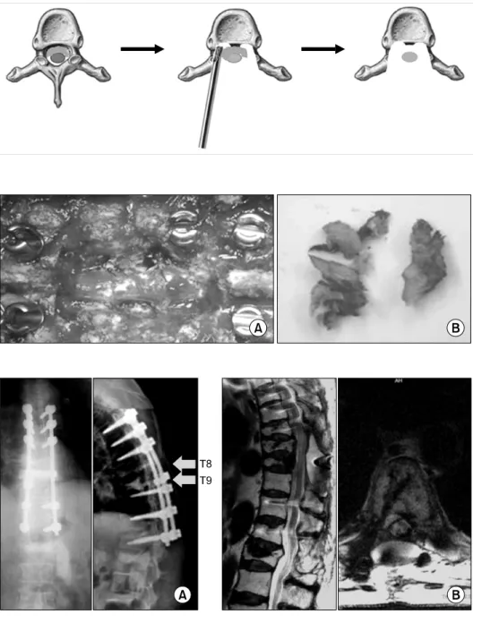 Fig.  3.  Schematic  illustration  shows  laminectomy  and   sub-traction  of  pedicles  and   po-sterior  portion  of  the  vertebral  body