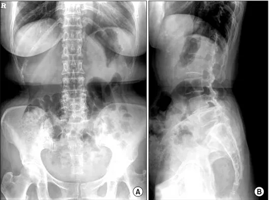 Fig.  1.  Preoperative  radiographs  of  the  lumbar  spine.  Lateral  radiograph  showing   spondylo-listhesis  at  L4/5.단하여 수술을 하지 않았던 증례 모두에서 단순히 도파민 항진제 투여로 증상의 호전을 경험하였다