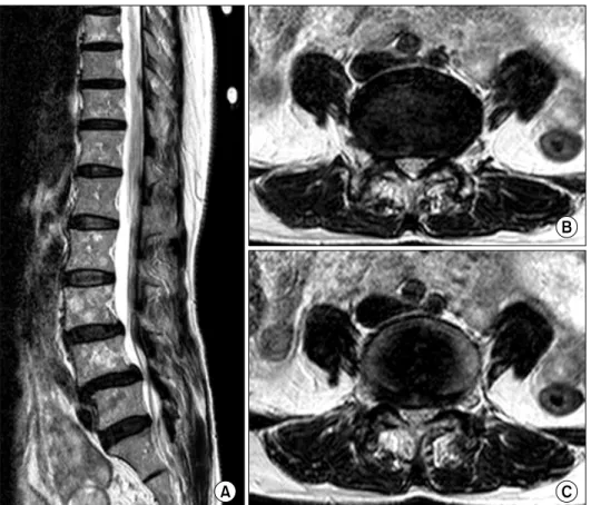 Fig.  2.  Preoperative  MRI  imag- imag-ing. MRI showed spinal stenosis at  L4/5.  B,  L4/5;  C,  L4/5.
