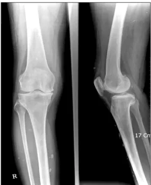 Fig.  4.  Radiograph  of  the  right  knee.  Radiograph  shows  arthritic change  of  the  knee.