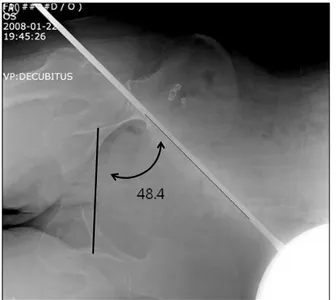 Fig.  2.  The  photograph  of  the  anteroposterior  radiograph  imaging technique  in  lateral  decubitus  position  using  goniometer.
