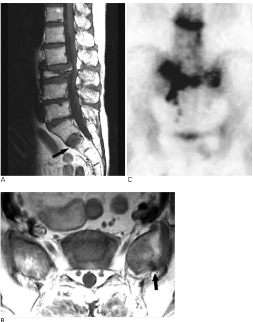 Fig. 1. 61-year-old woman with com- com-pression fracture at L3 body and  insuf-ficiency fracture at upper portion of S2 body.
