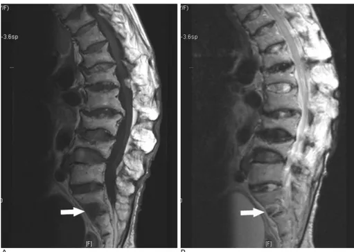 Fig. 2. 73-year-old woman with multi- multi-ple compression fractures at  T/L-spine.