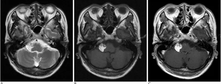 Fig. 2. Left vertebral angiogram. The vascular entangled mass fed by the right AICA is demonstrated