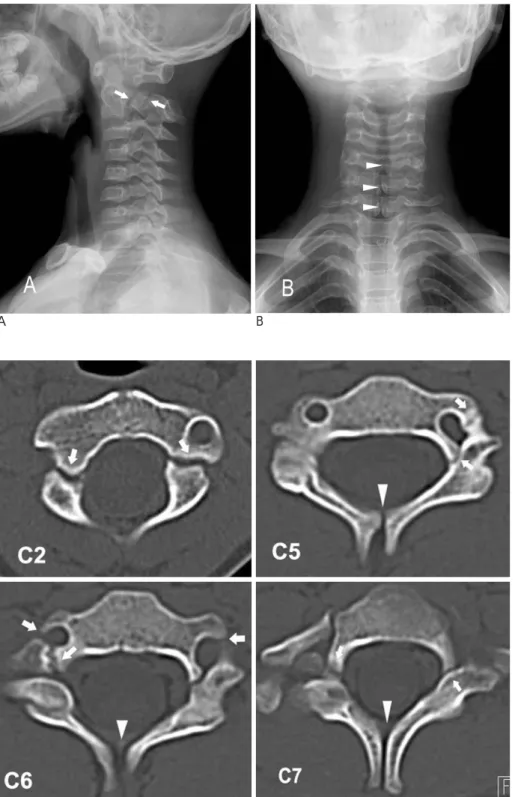 Fig. 1. Plain radiographs show spondy- spondy-lolytic defects (arrows) and associated spina bifida occulta (arrowhead).