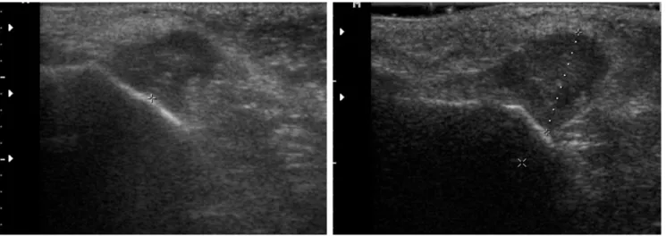 Fig. 1. A. Initial ultrasonography detected a mass with an irregular shape and partially ill-defined margins; it was a hypoechoic mass with central hyperechogenicity