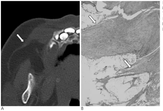 Fig. 3. A. On CT in the bone window setting, the lateral end of the mass was pointed (arrow)