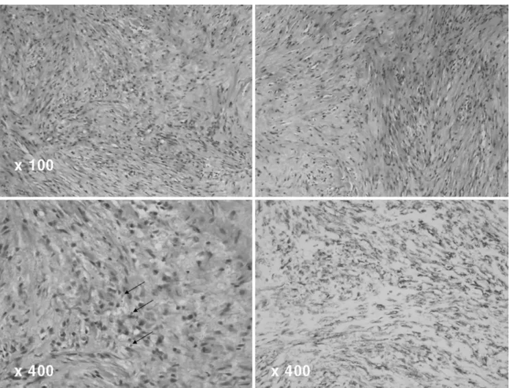 Fig. 4. Photomicrograph of a low-power field (×100, H &amp; E) depicted varying cellularity with hypercellular areas of spindle cells admixed with less cellular hyalinized zones