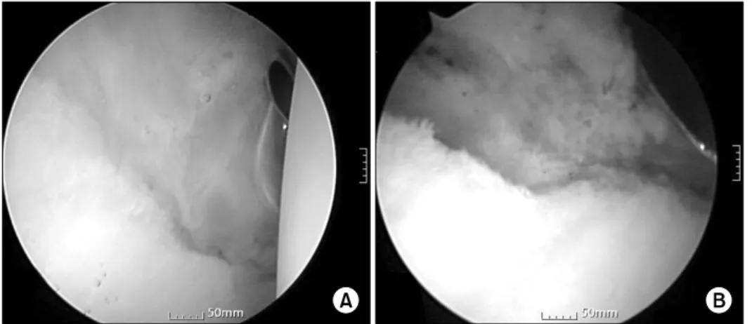 Fig.  1.  (A)  This  photograph  shows  labral  adhesion  at   se-cond-look  arthroscopy