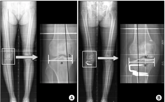 Fig.  1.  (A)  The  mechanical  axis  %  (MA%)  shown  on  the  preoperative  ortho-roentgenogram  is  evaluated  by  percentile  denotation  [(b/a)×100]