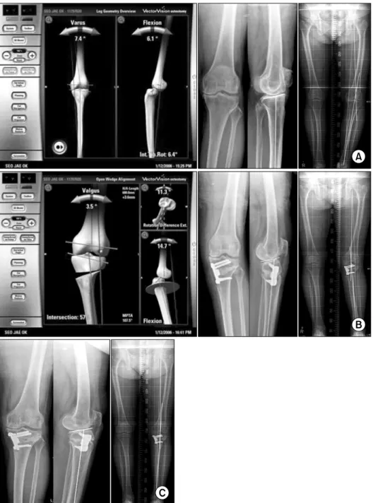 Fig.  2.  Change  of  mechanical  axis  after  the  open  wedge  high  tibial  osteotomy  using  navigation  system