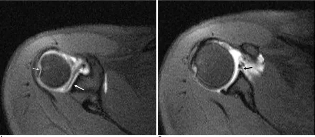 Fig. 6. MR arthrographic image of 19-year-old man with previous trauma history 