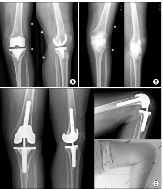 Fig.  1.  This  65  year-old  woman  visited our clinic with infection of left  total  knee  arthroplasty  that  was  done  in  other  hospital  39  months  ago  (A)